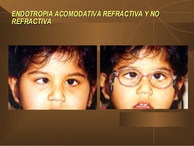 endotropia no acomodativa